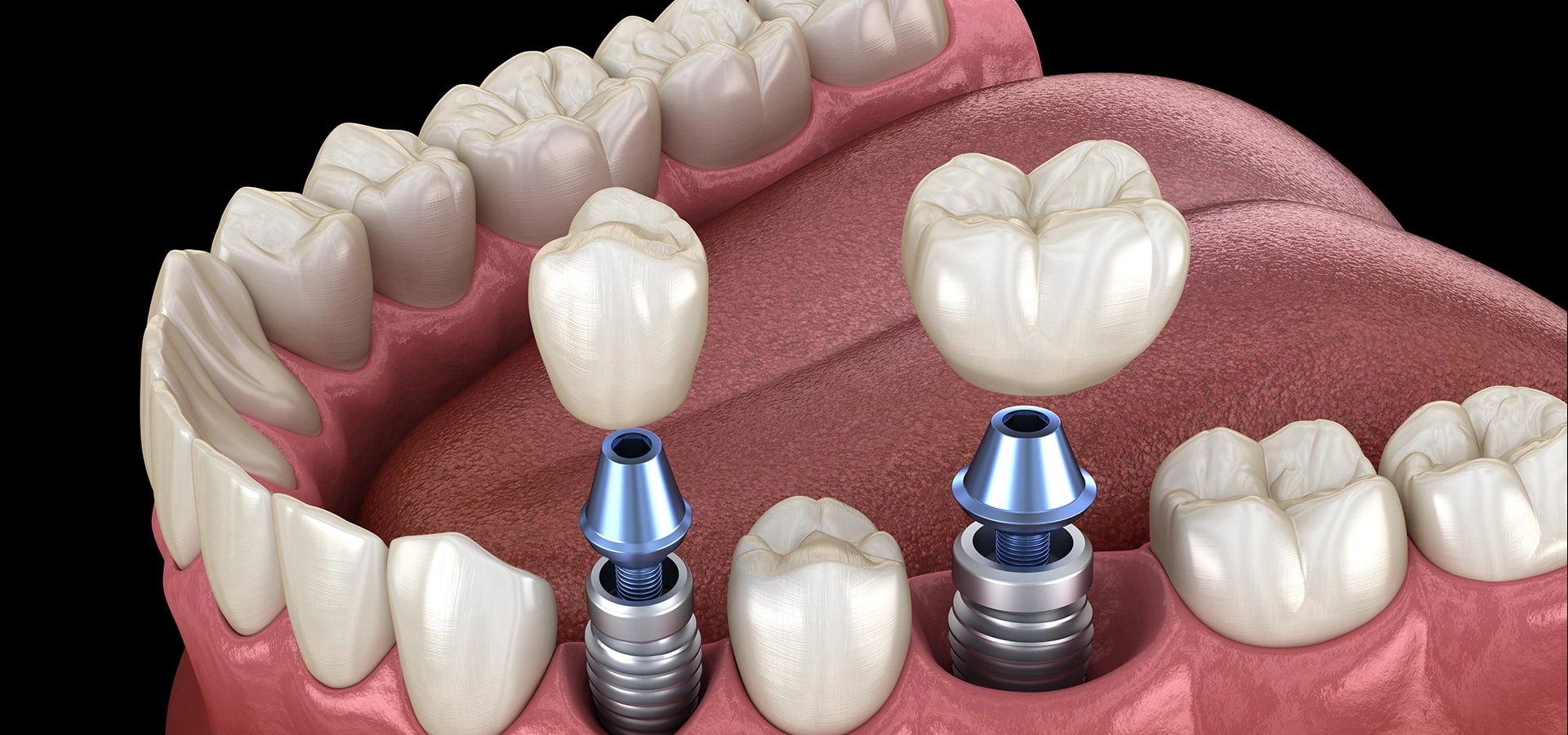 Dental implant model showing tooth replacements with implant posts and crowns on gum structure.