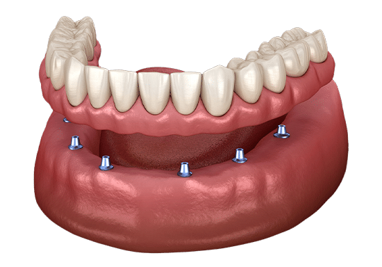 Dental implant model showing prosthetic teeth anchored to jawbone with implant posts.