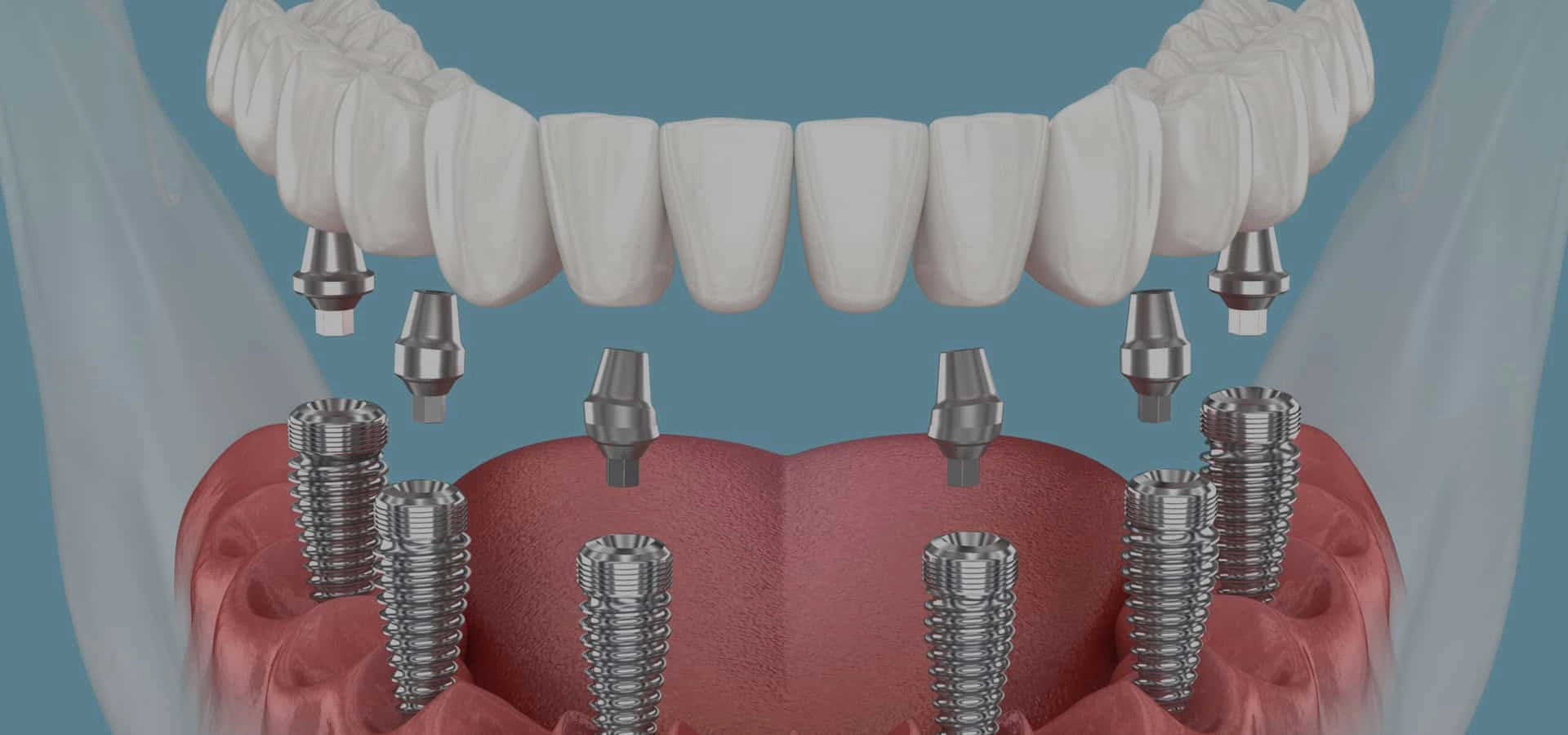 Dental implant diagram showing prosthetic teeth attached to implant posts in jawbone model.