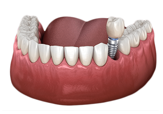 Dental implant model showing tooth replacement procedure with crown and implant fixture in gum tissue.