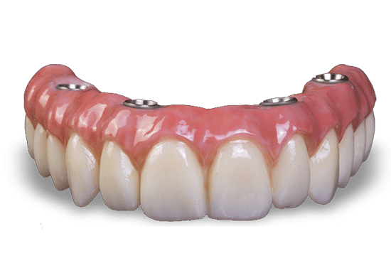 Digital dental implant model showing prosthetic teeth with pink gum tissue simulation.