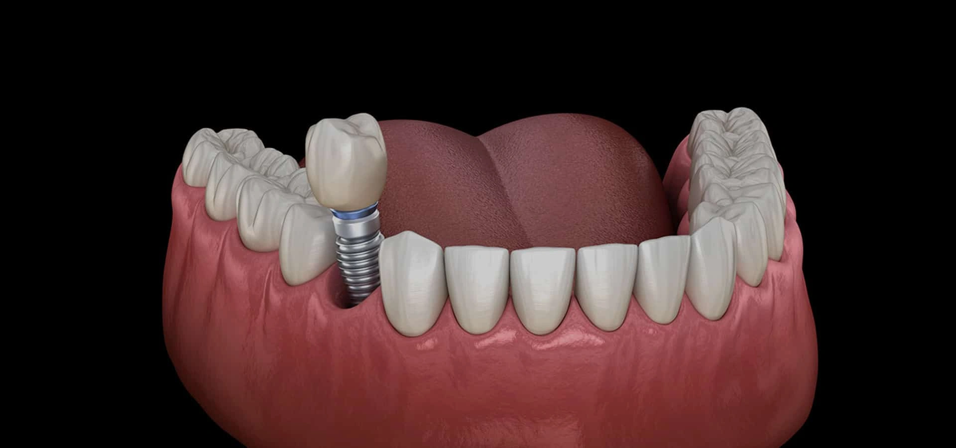 3D dental implant model showing tooth replacement in upper jaw with crown and natural teeth.