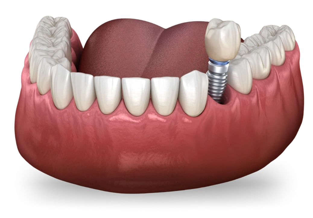 Dental implant model showing tooth replacement with artificial crown and implant post in gum tissue.