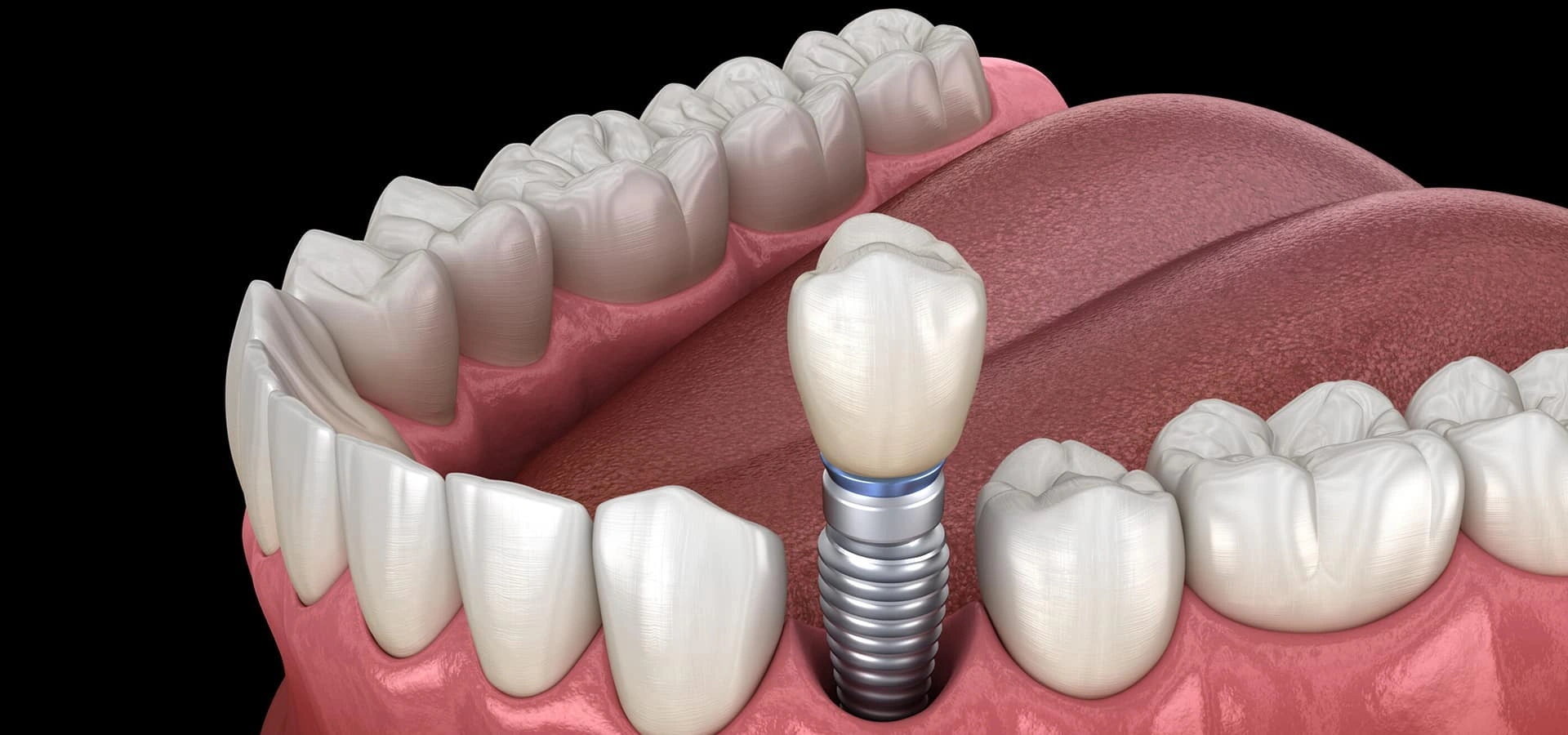 Dental implant illustration showing artificial tooth fixture in jawbone model with surrounding natural teeth.