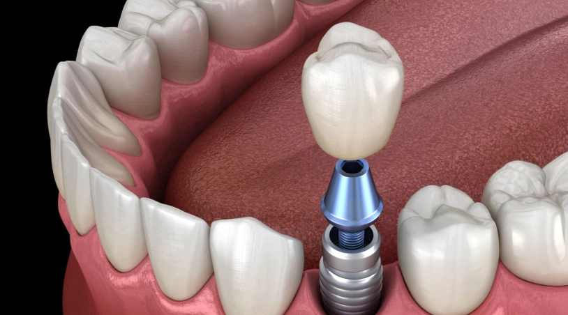 Dental implant diagram showing titanium post and crown restoration in jawbone model.