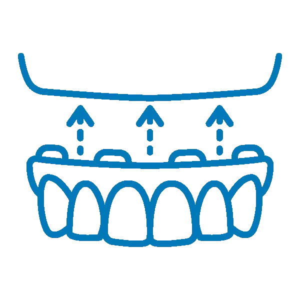 Dental implants diagram showing teeth attached to upper palate structure with directional arrows.