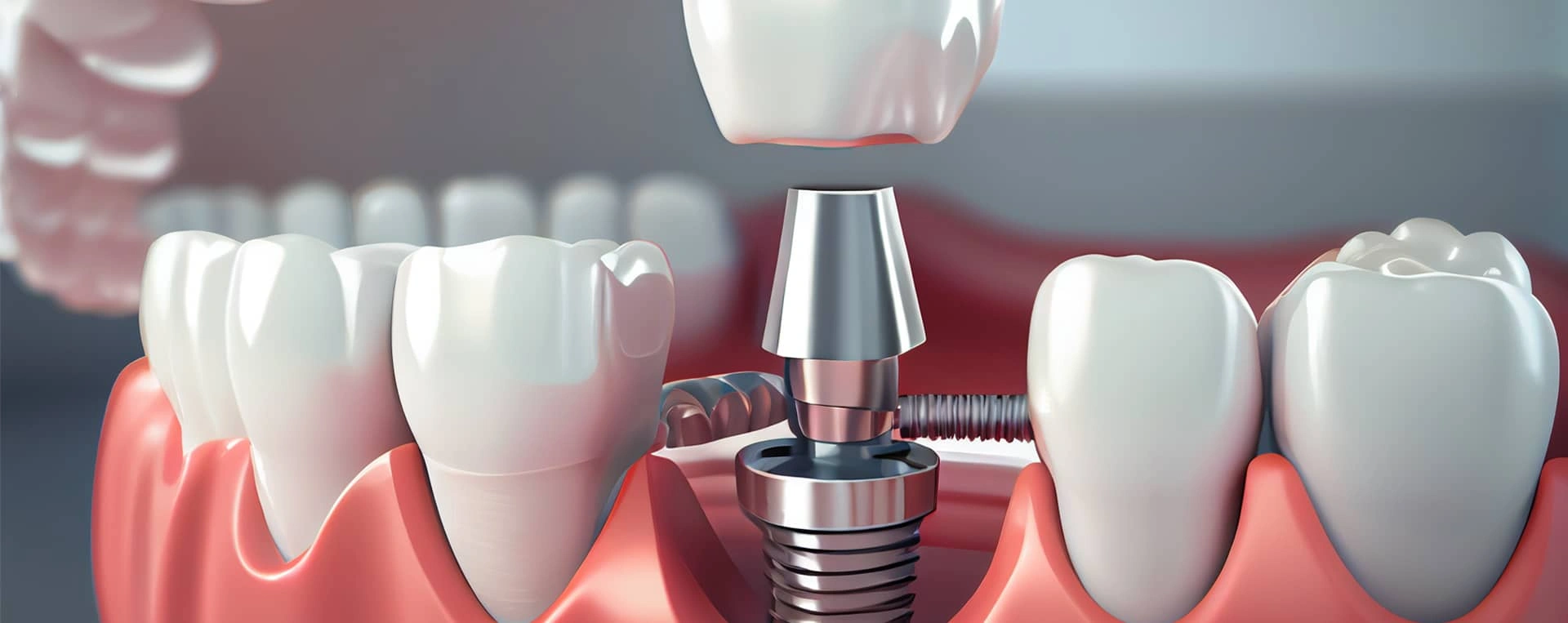 Dental implant model showing tooth replacement procedure with crown placement on implant post among natural teeth.