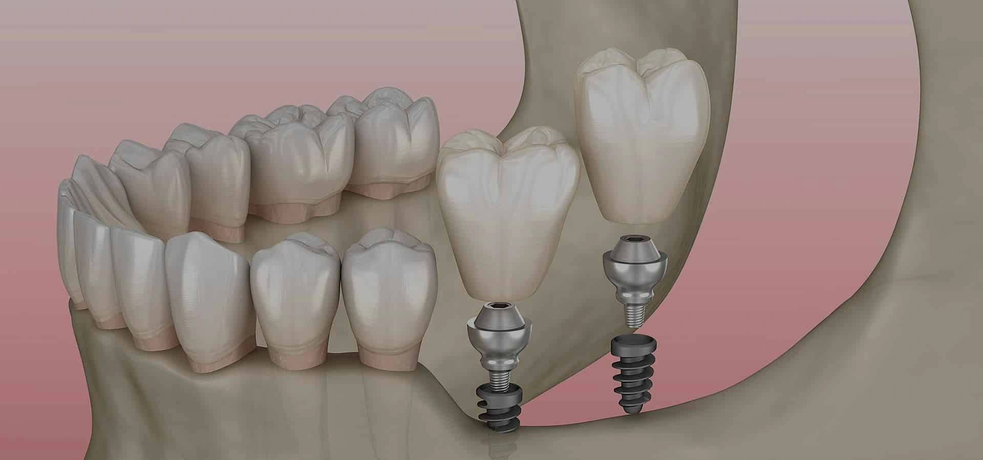 Dental implant diagram showing tooth replacement components and jaw structure against pink background.