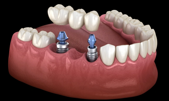 Dental implant model showing two blue implant posts in pink gum tissue with ceramic crowns.