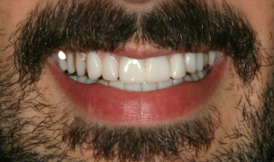 Close-up of smiling bearded man displaying bright white teeth and healthy smile