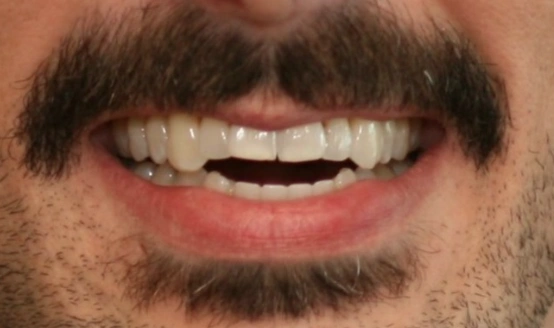 Close-up of man's smile showing teeth and facial hair, dental care context