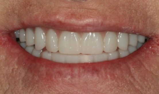 Close-up of upper teeth showing dental work, likely implants or cosmetic dentistry results.