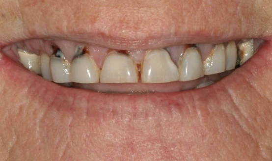 Close-up of adult teeth showing spacing gaps and discoloration requiring dental treatment.
