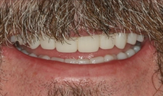 Close-up of man's smile showing straight, white teeth and dental work results