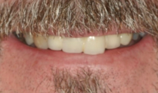 Close-up of male smile showing straight, white teeth and dental work results.