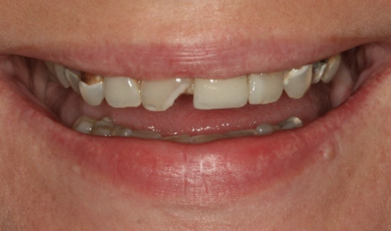 Close-up of smile showing teeth with gap and dental misalignment requiring orthodontic treatment.