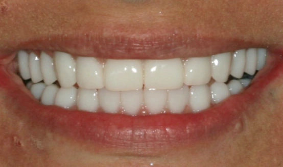 Close-up of a bright, evenly-spaced smile showing white teeth and natural lips.